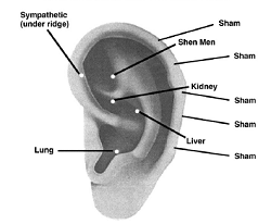 acupuncture